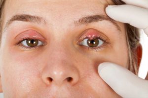 How Is Chalazion Treated? | Medivision